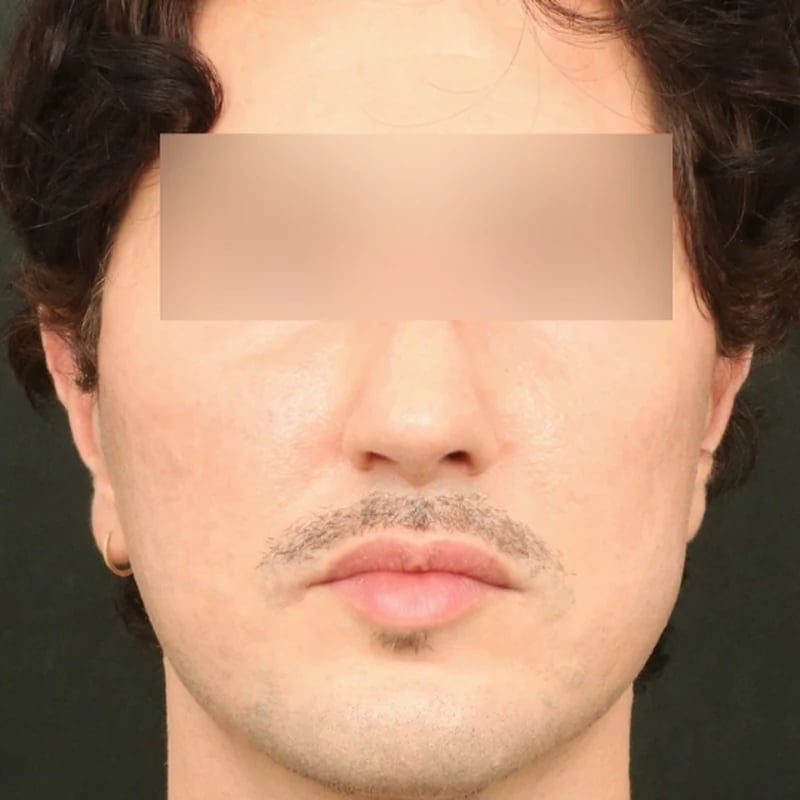 Fat Transfer Before & After Image