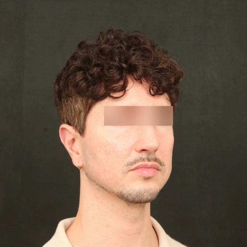 Fat Transfer Before & After Image