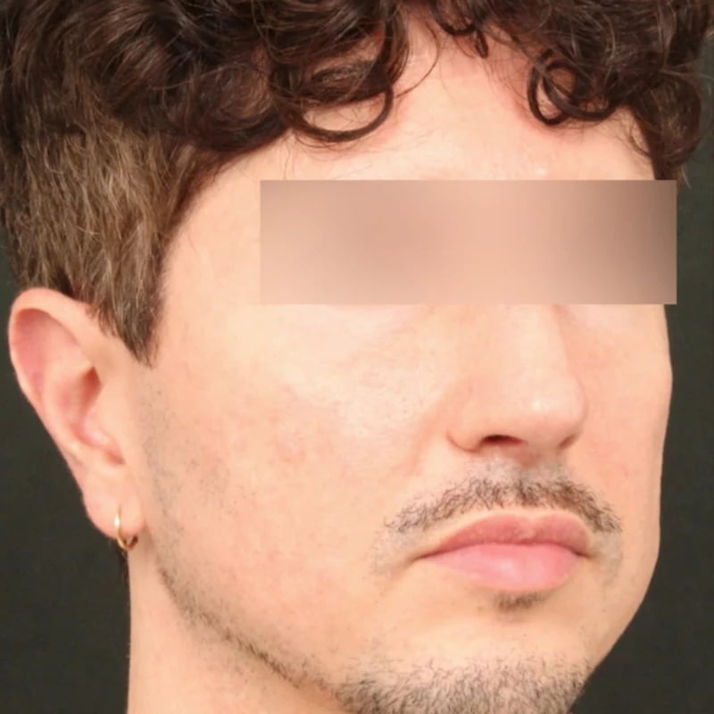 Fat Transfer Before & After Image