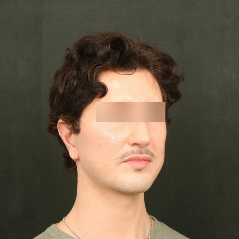 Fat Transfer Before & After Image