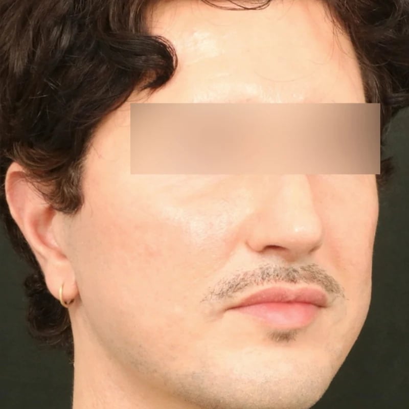 Fat Transfer Before & After Image