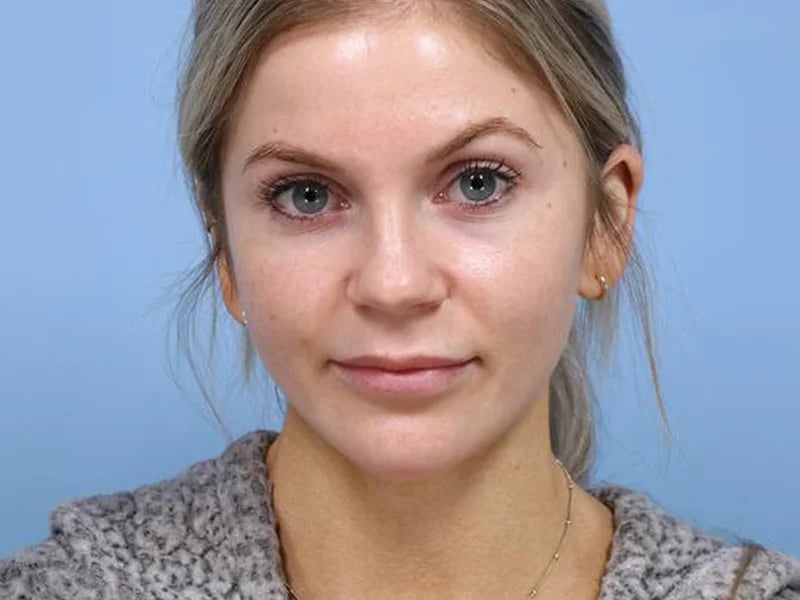Lip Lift Before & After Image