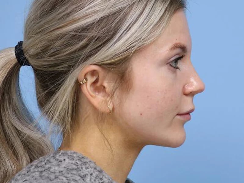 Lip Lift Before & After Image