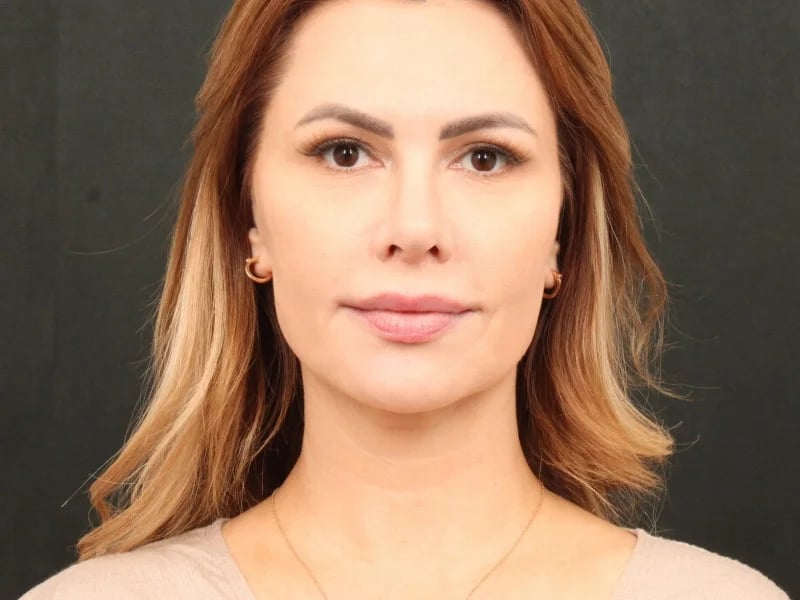 Lip Lift Before & After Image