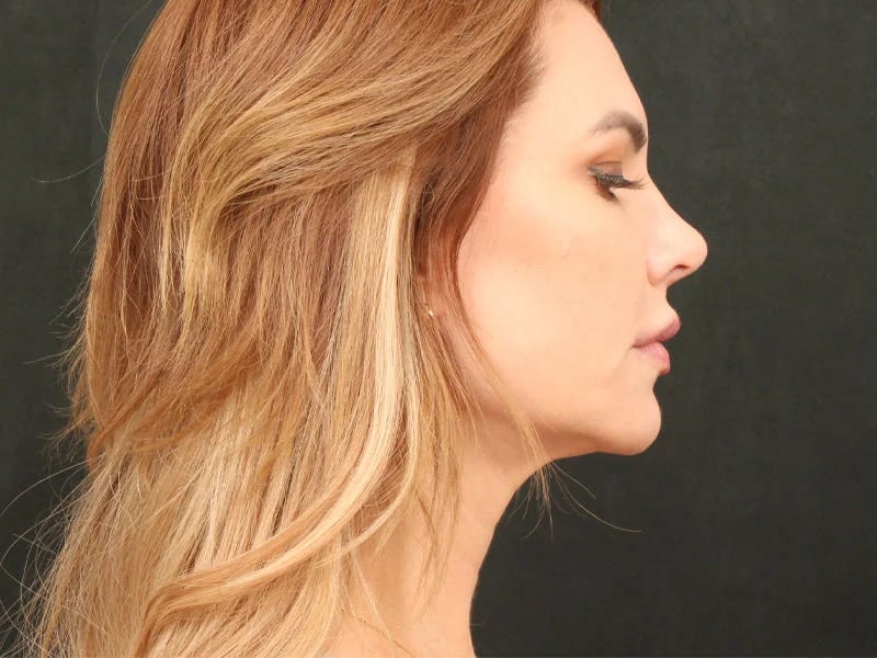 Lip Lift Before & After Image