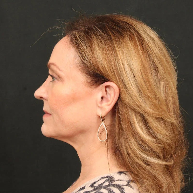Hair Transplant Before & After Image