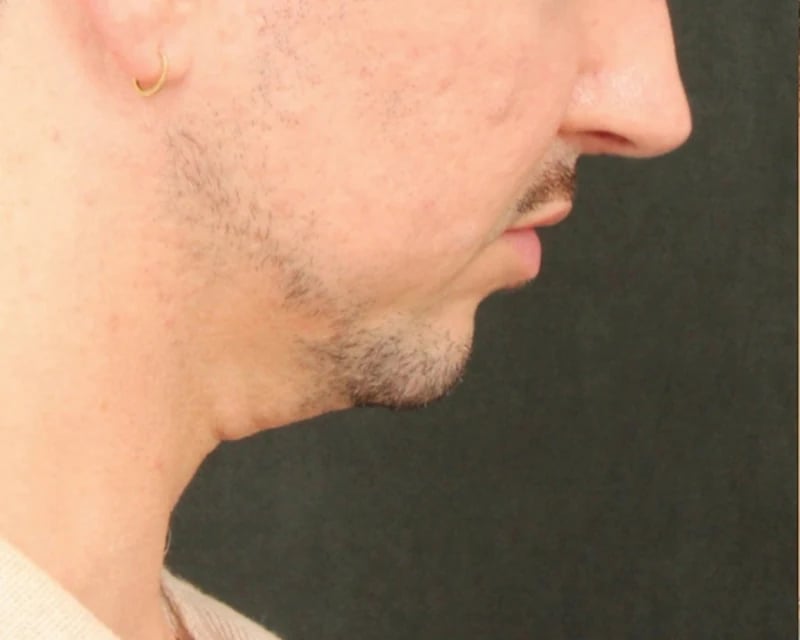 Chin Implant Before & After Image