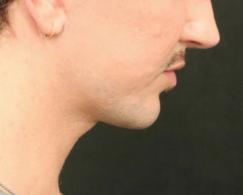 Chin Implant Before & After Image