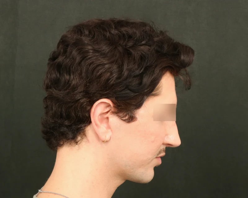 Chin Implant Before & After Image