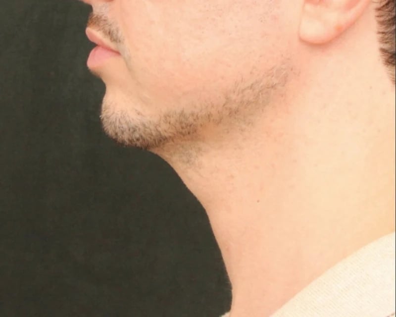 Chin Implant Before & After Image