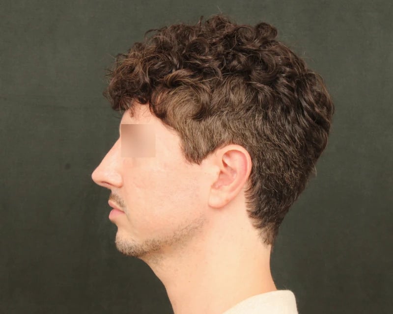 Chin Implant Before & After Image
