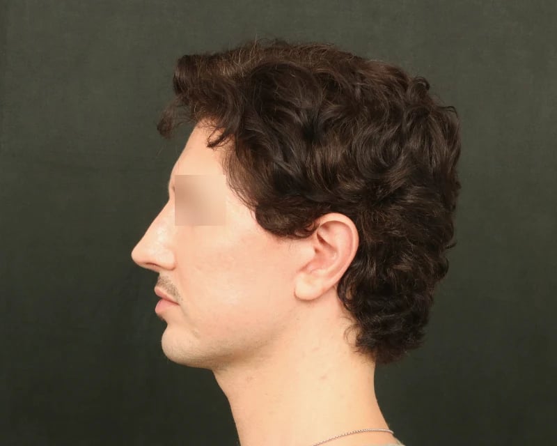 Chin Implant Before & After Image