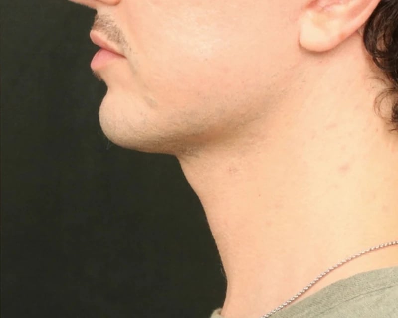 Chin Implant Before & After Image