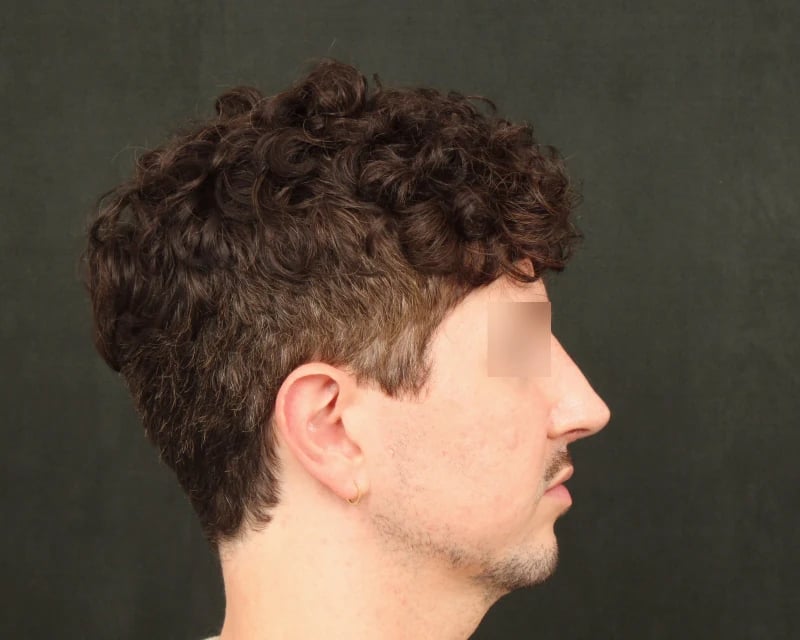 Chin Implant Before & After Image
