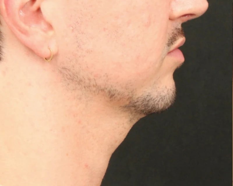 Chin Implant Before & After Image