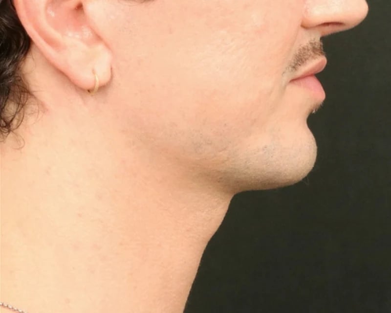 Chin Implant Before & After Image