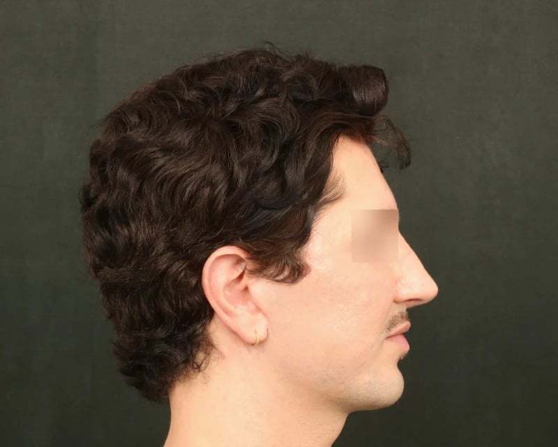 Chin Implant Before & After Image