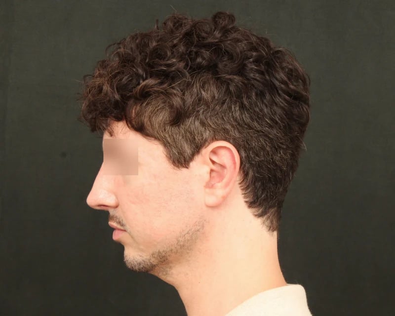 Chin Implant Before & After Image