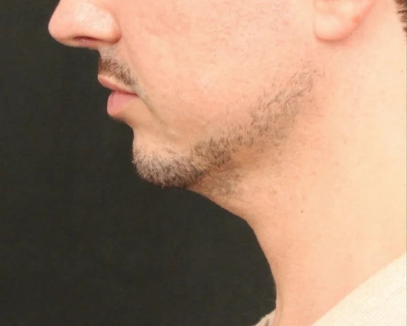 Chin Implant Before & After Image