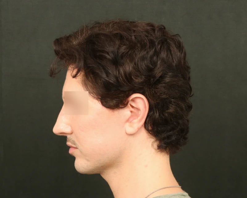 Chin Implant Before & After Image