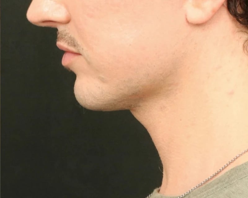 Chin Implant Before & After Image