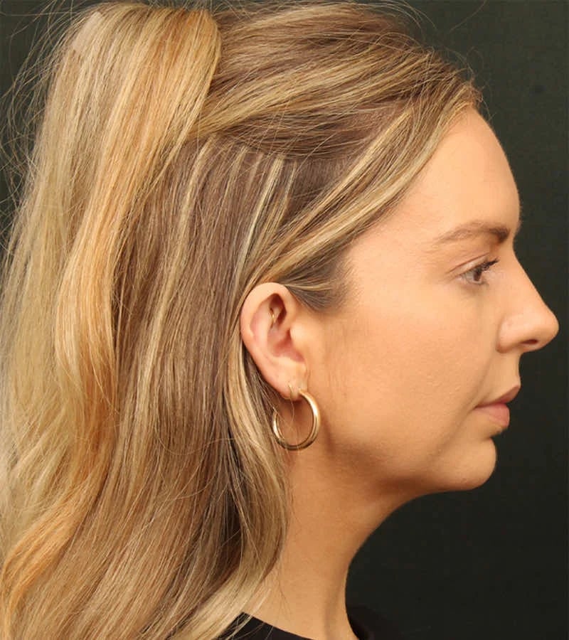 Patient Before Photo
