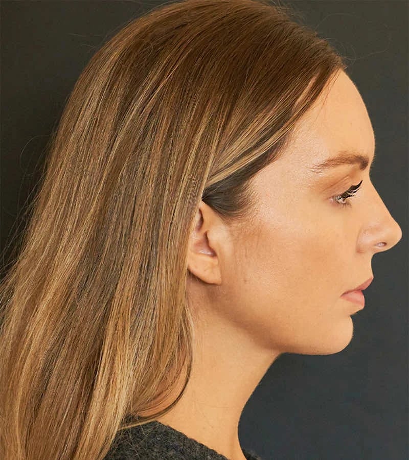 Patient After Photo
