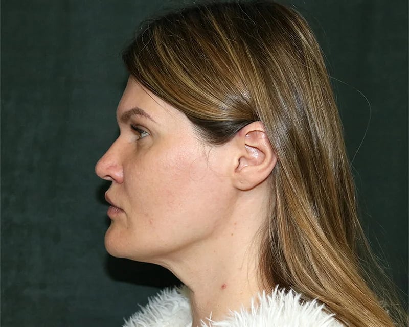 Neck Lift (Holiday Neck Lift®) Before & After Image
