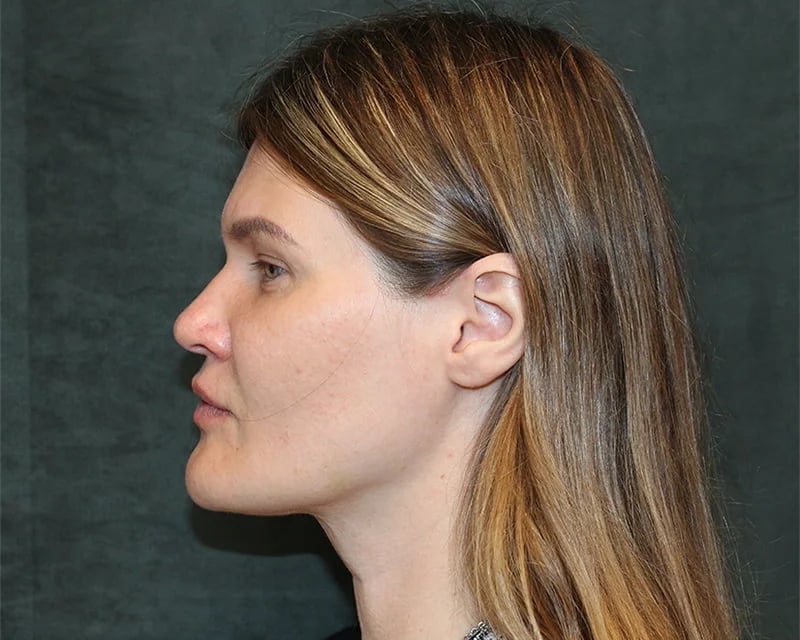 Neck Lift (Holiday Neck Lift®) Before & After Image