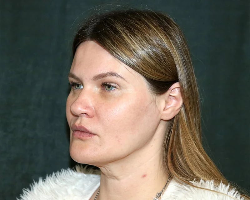 Neck Lift (Holiday Neck Lift®) Before & After Image