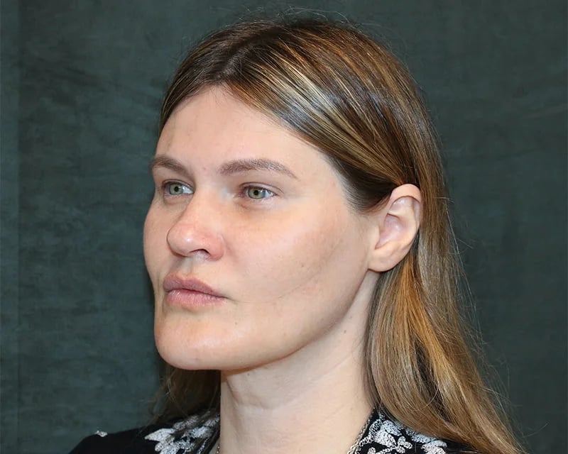 Neck Lift (Holiday Neck Lift®) Before & After Image