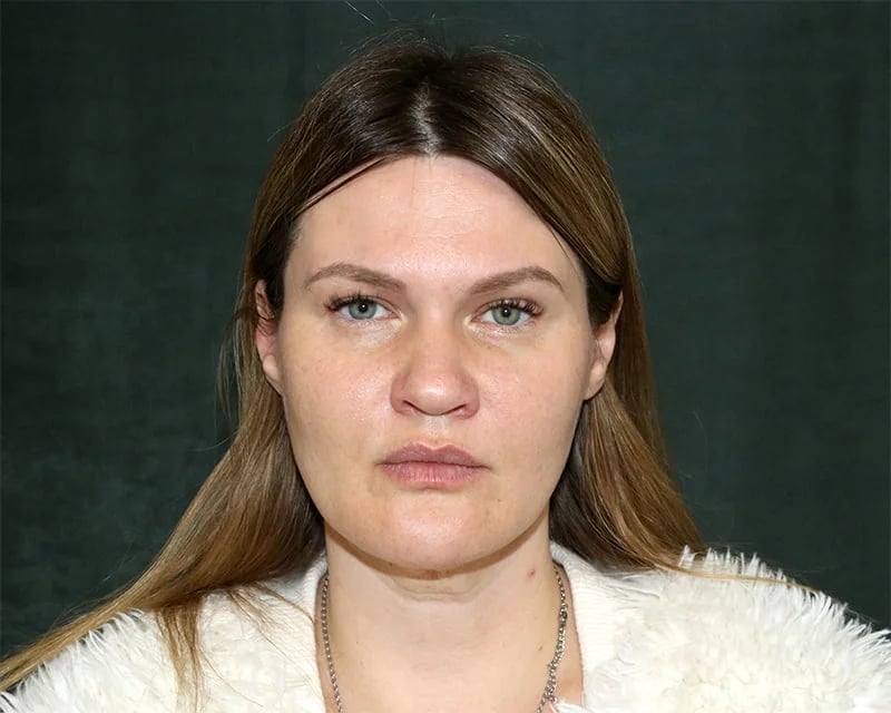 Neck Lift (Holiday Neck Lift®) Before & After Image
