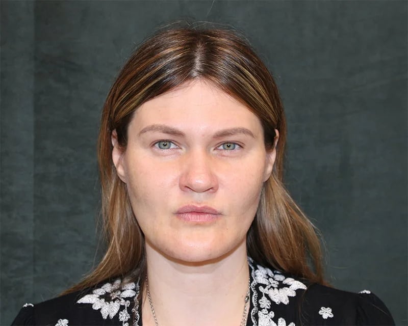 Neck Lift (Holiday Neck Lift®) Before & After Image