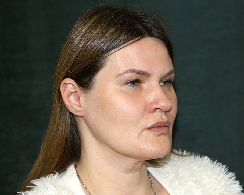 Neck Lift (Holiday Neck Lift®) Before & After Image