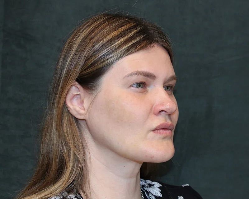 Neck Lift (Holiday Neck Lift®) Before & After Image