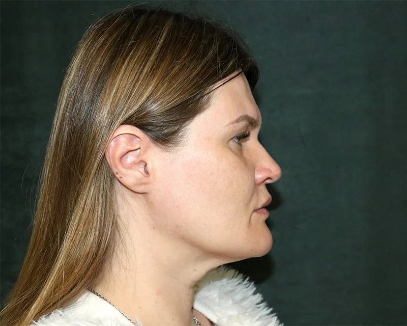 Patient Before Photo