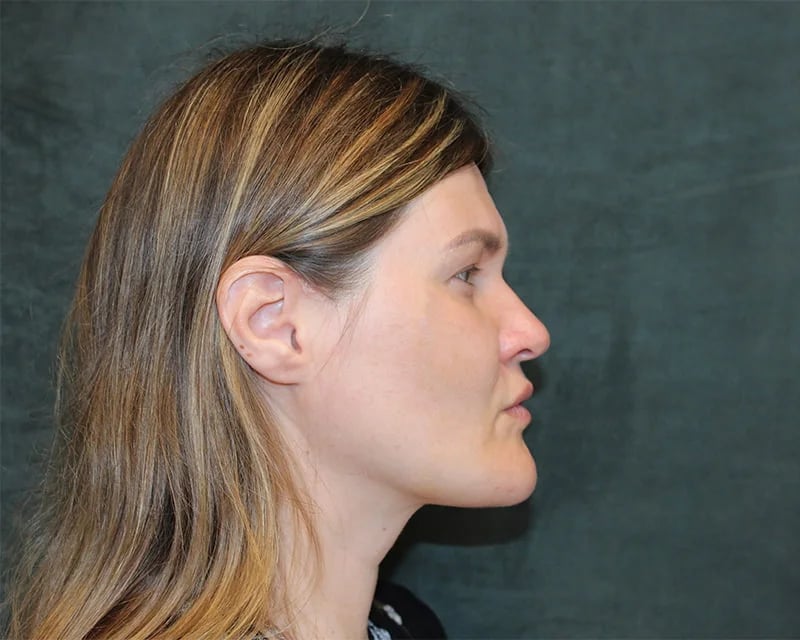 Patient After Photo