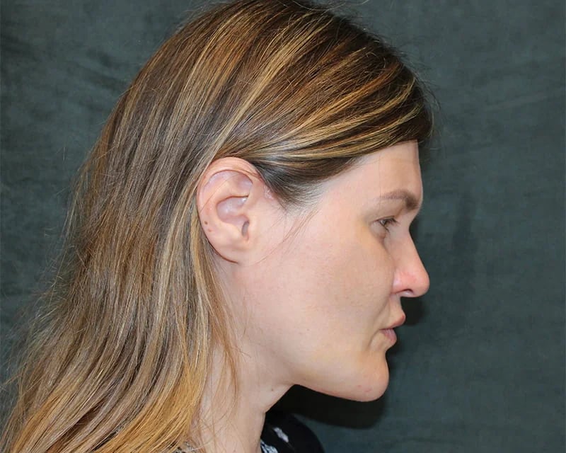 Neck Lift (Holiday Neck Lift®) Before & After Image
