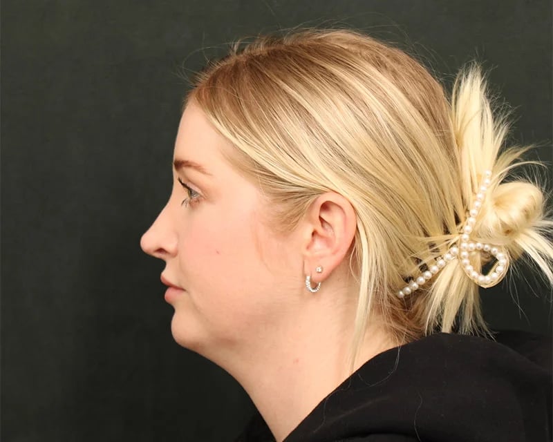 Holiday Neck Lift before and after results by Dr. Harris Beverly Hills