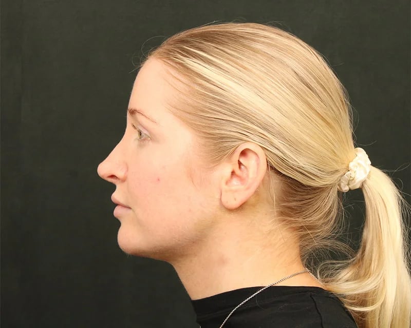 Holiday Neck Lift before and after results by Dr. Harris Beverly Hills