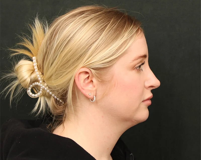 Holiday Neck Lift before and after results by Dr. Harris Beverly Hills