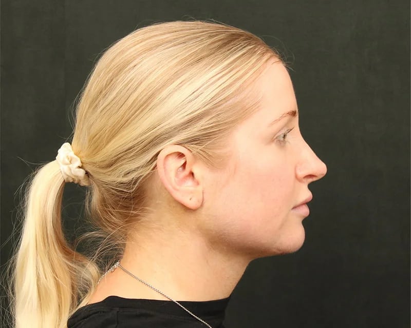 Holiday Neck Lift before and after results by Dr. Harris Beverly Hills