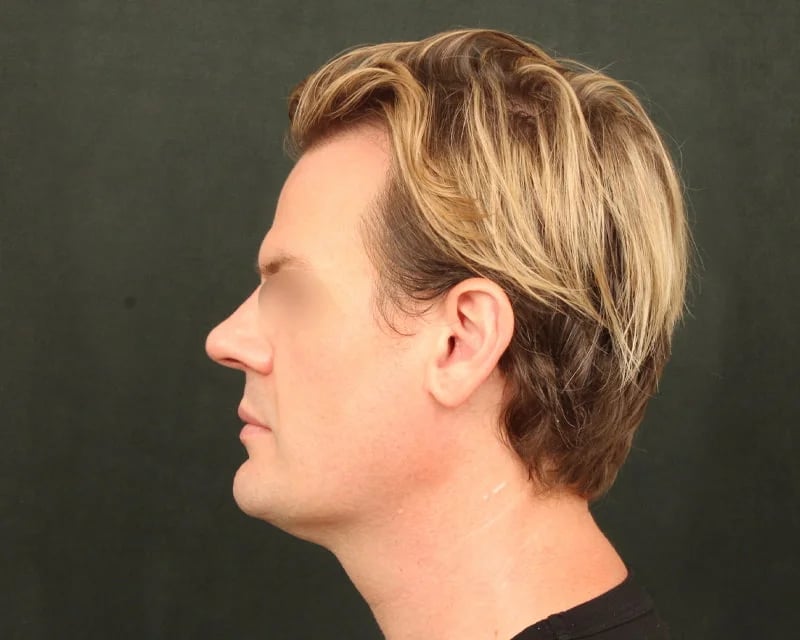 Neck Lift (Holiday Neck Lift®) Before & After Image