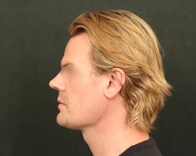 Neck Lift (Holiday Neck Lift®) Before & After Image