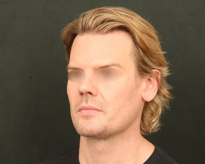 Neck Lift (Holiday Neck Lift®) Before & After Image