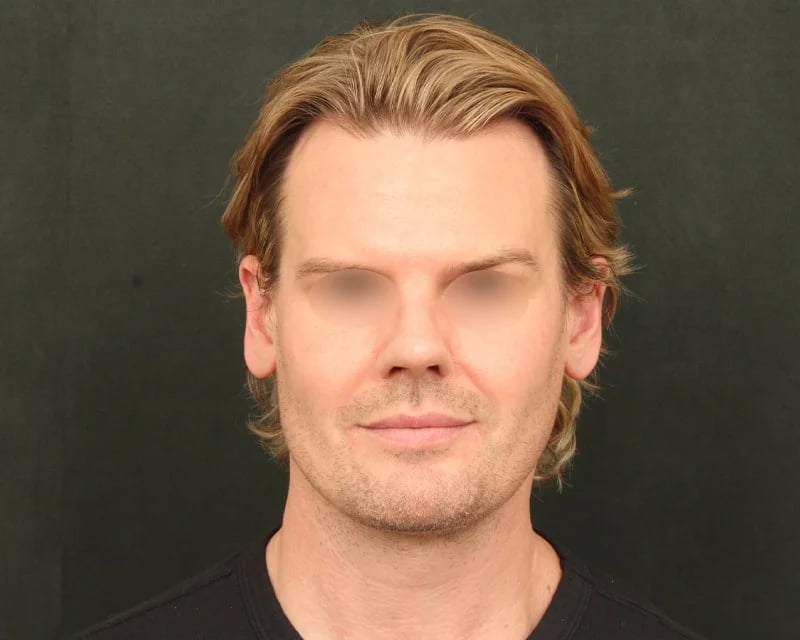 Neck Lift (Holiday Neck Lift®) Before & After Image