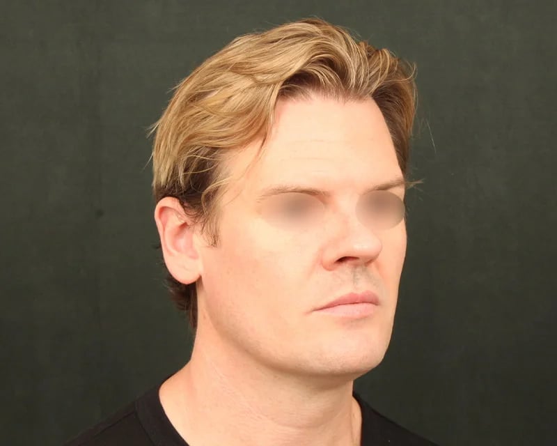Neck Lift (Holiday Neck Lift®) Before & After Image