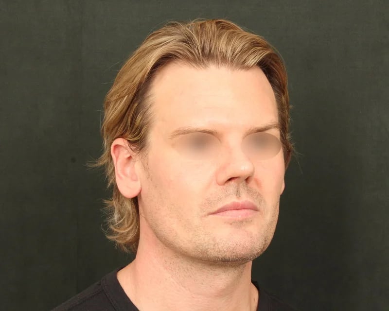 Neck Lift (Holiday Neck Lift®) Before & After Image