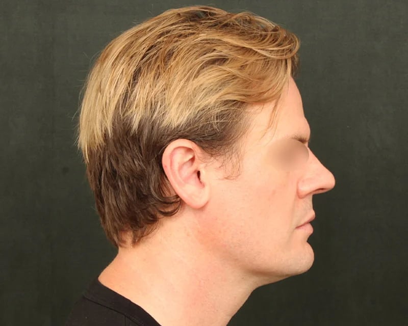 Neck Lift (Holiday Neck Lift®) Before & After Image