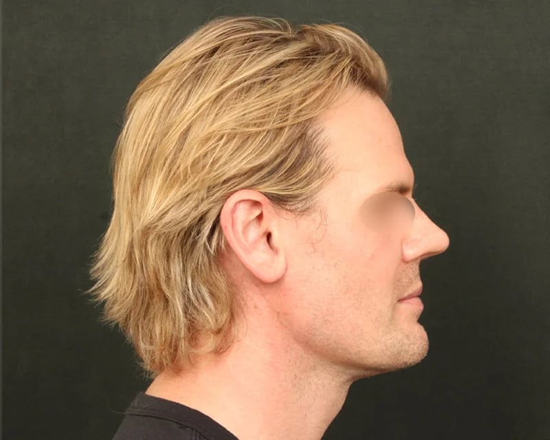 Neck Lift (Holiday Neck Lift®) Before & After Image